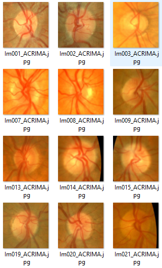 GlaucomaDetection preview