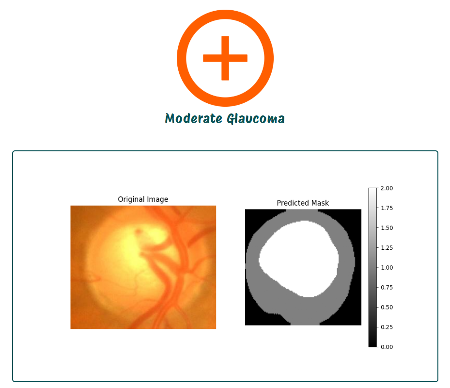 GlaucomaDetection preview